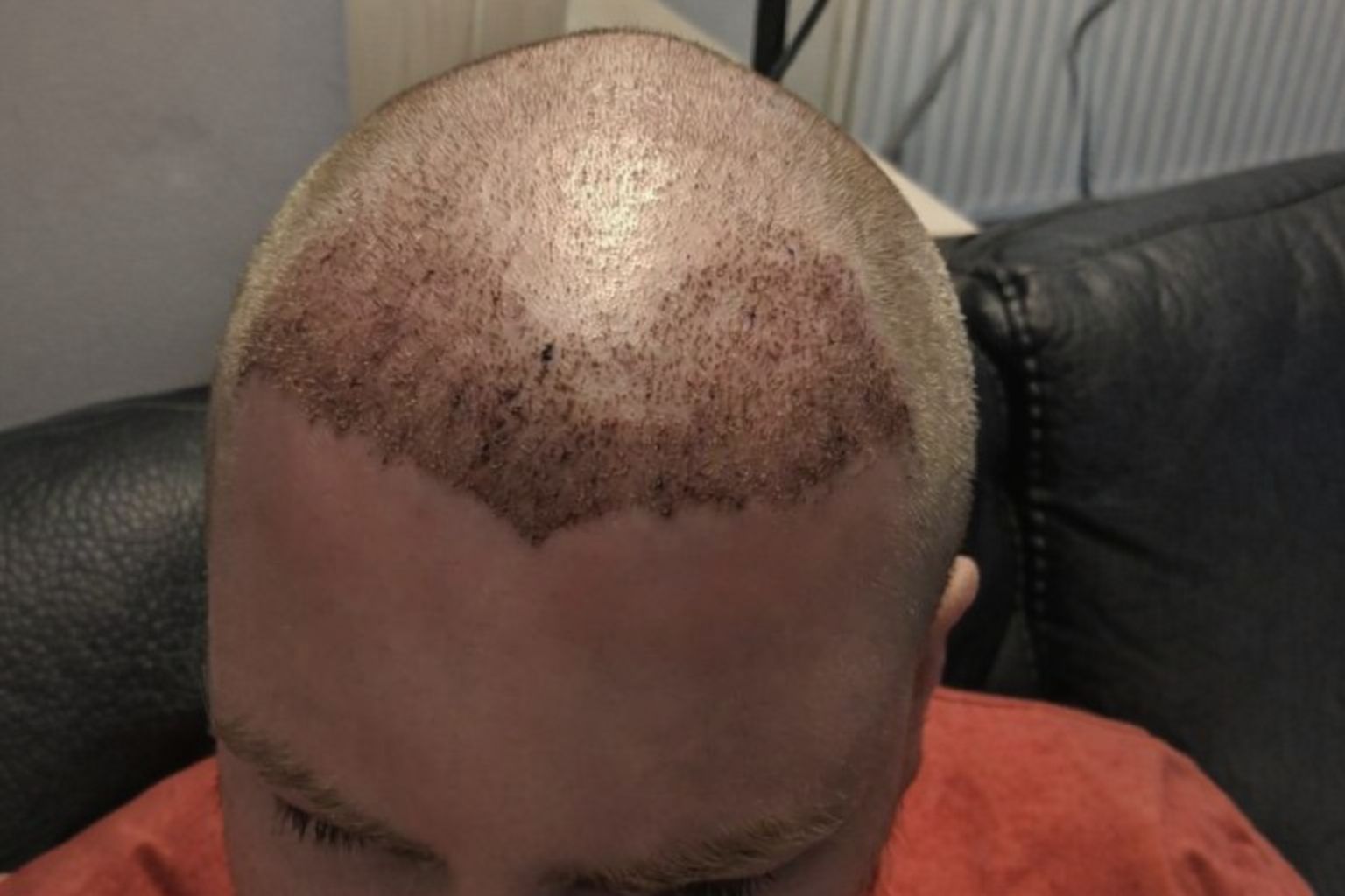 Närbild av rakad hjässa med röda prickar och skorpor efter ingrepp